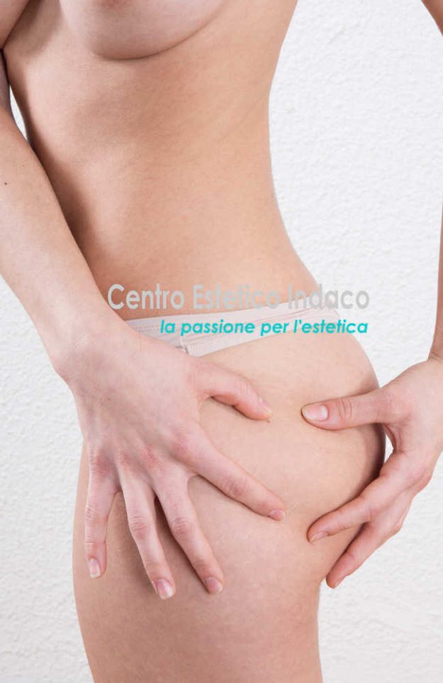cellulite-edematosa