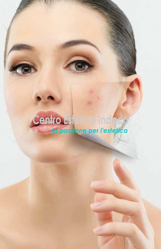 ACNE VISO