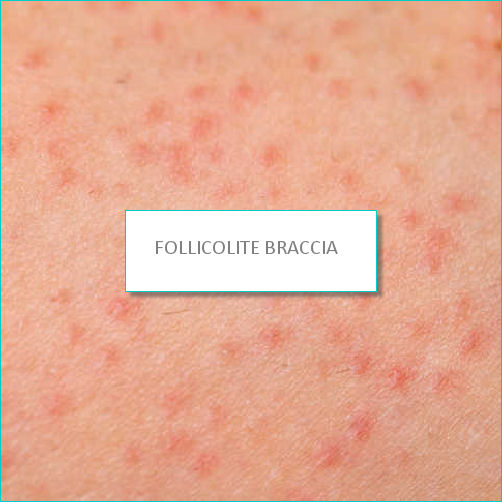 FOLLICOLITE BRACCIA