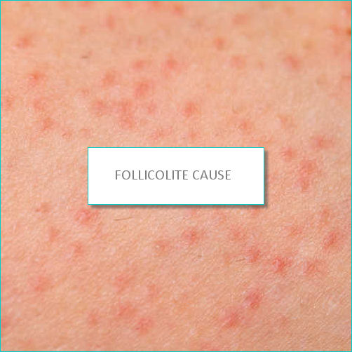 FOLLICOLITE CAUSE