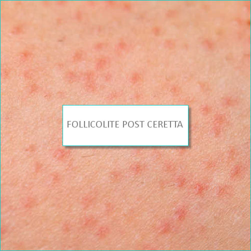 follicolite post ceretta