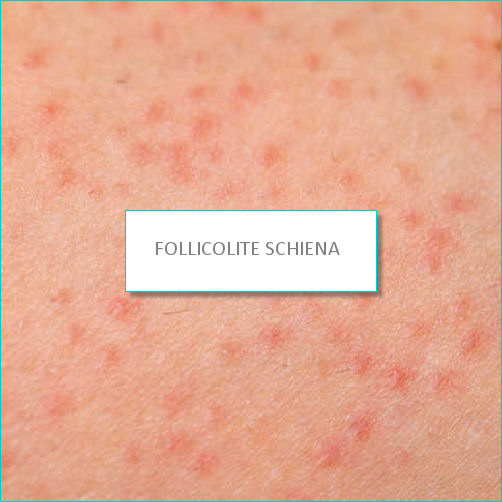 follicolite schiena