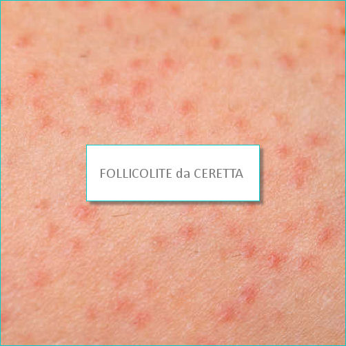 FOLLICOLITE DA CERETTA