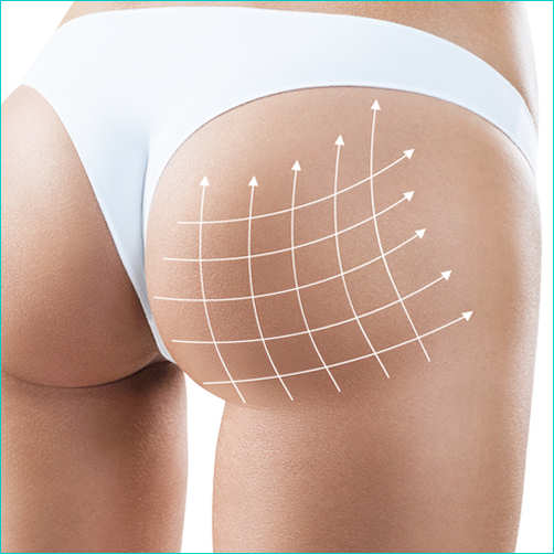 cellulite come eliminarla