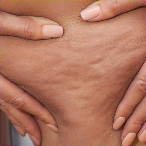 combattere-la-cellulite